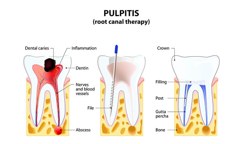 Endodontic Treatments