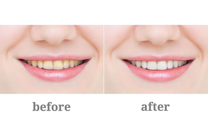 Before and after images of our Teeth whitening process in cosmetic dentistry