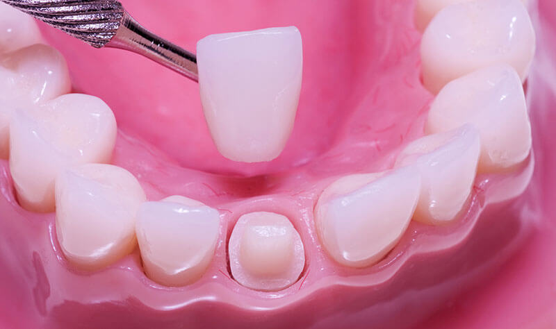 Crowns and inlays/overlays next to a damaged tooth