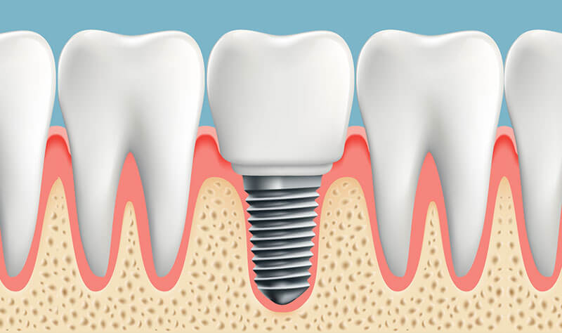 Dental implants