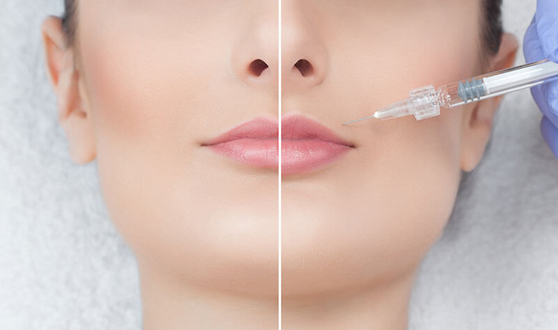 Lady undergoing Dermal filler injections 