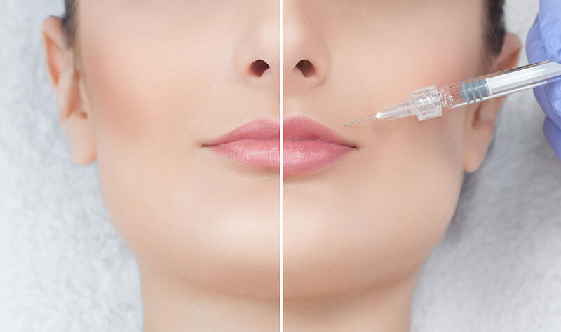 Lady undergoing Dermal filler injections