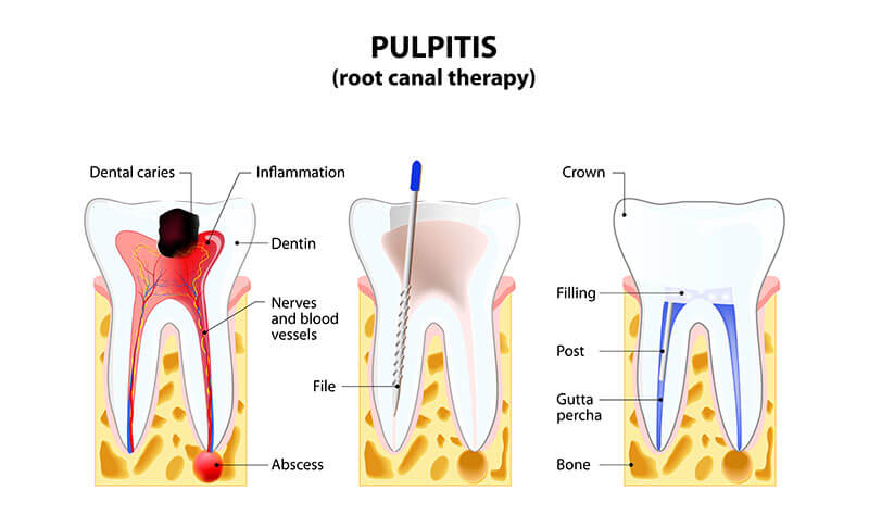 Endodontic treatment