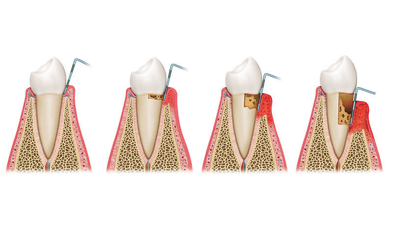 Gum Disease | Chichester Periodontal Treatments Gum Disease | Chichester Periodontal Treatments