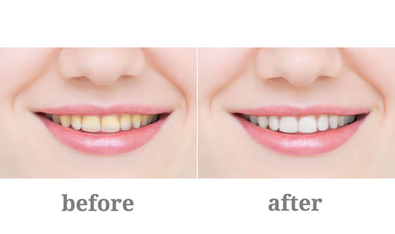 Before and after images of our Teeth whitening process in cosmetic dentistry Before and after images of our Teeth whitening process in cosmetic dentistry