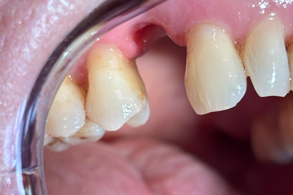 Bicon implants