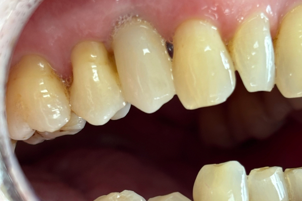 Bicon dental implant treatments in Chichester